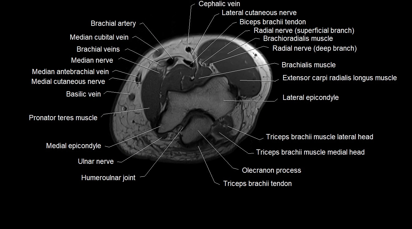Upper arm( humerus) cross section anatomy MRI 3T axial image 54.webp